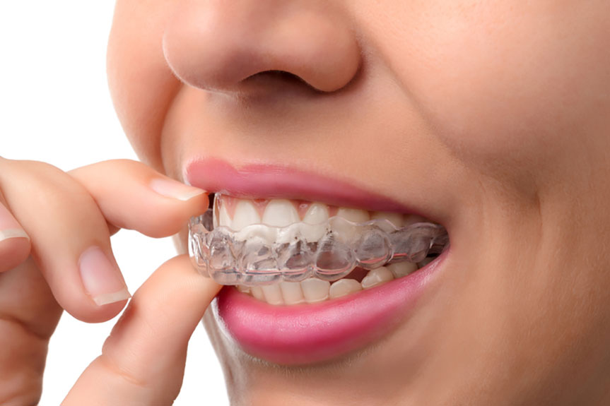 Invisalign clear aligners bhopal braces
