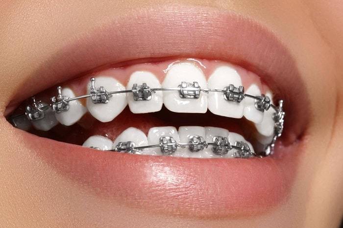 Metal non self ligating braces bhopal