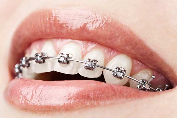 Metal self ligating braces bhopal