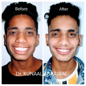 Braces Before and After