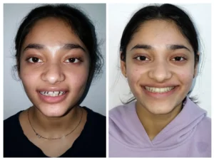 braces before and after