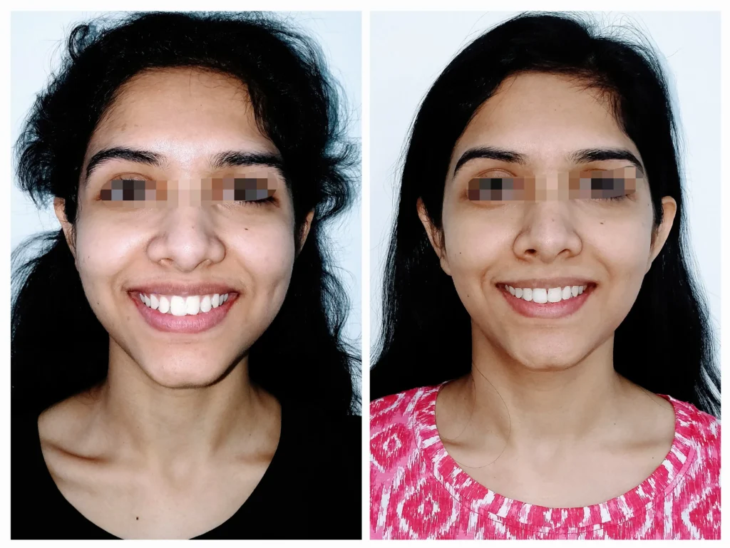 a patient revealing comparison of smile before and after orthodontic treatment
