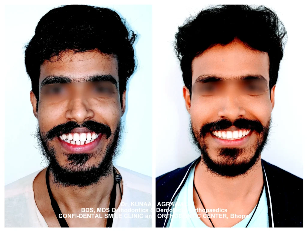 a patient revealing comparison of smile before and after orthodontic treatment