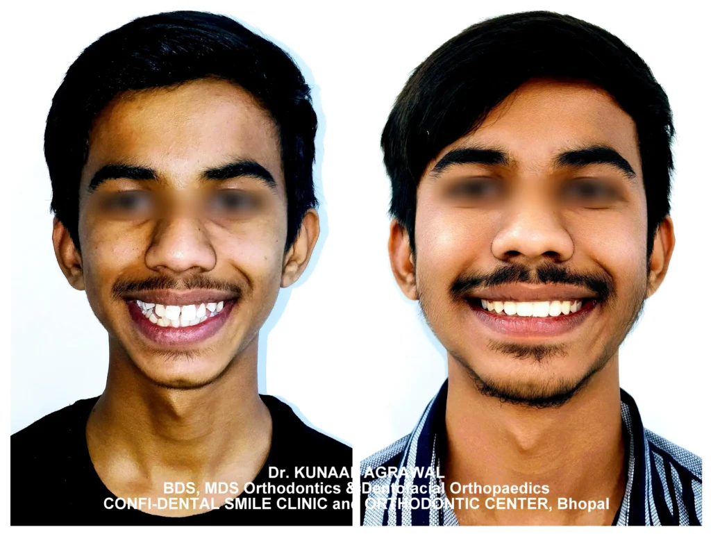 a patient revealing comparison of smile before and after orthodontic treatment