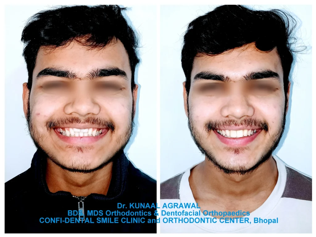a patient revealing comparison of smile before and after orthodontic treatment