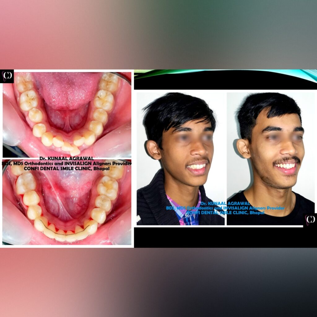 an intraoral and extraoral smile comparison image of a patient who underwent orthodontic or braces treatment at confi dental smile clinic, bhopal