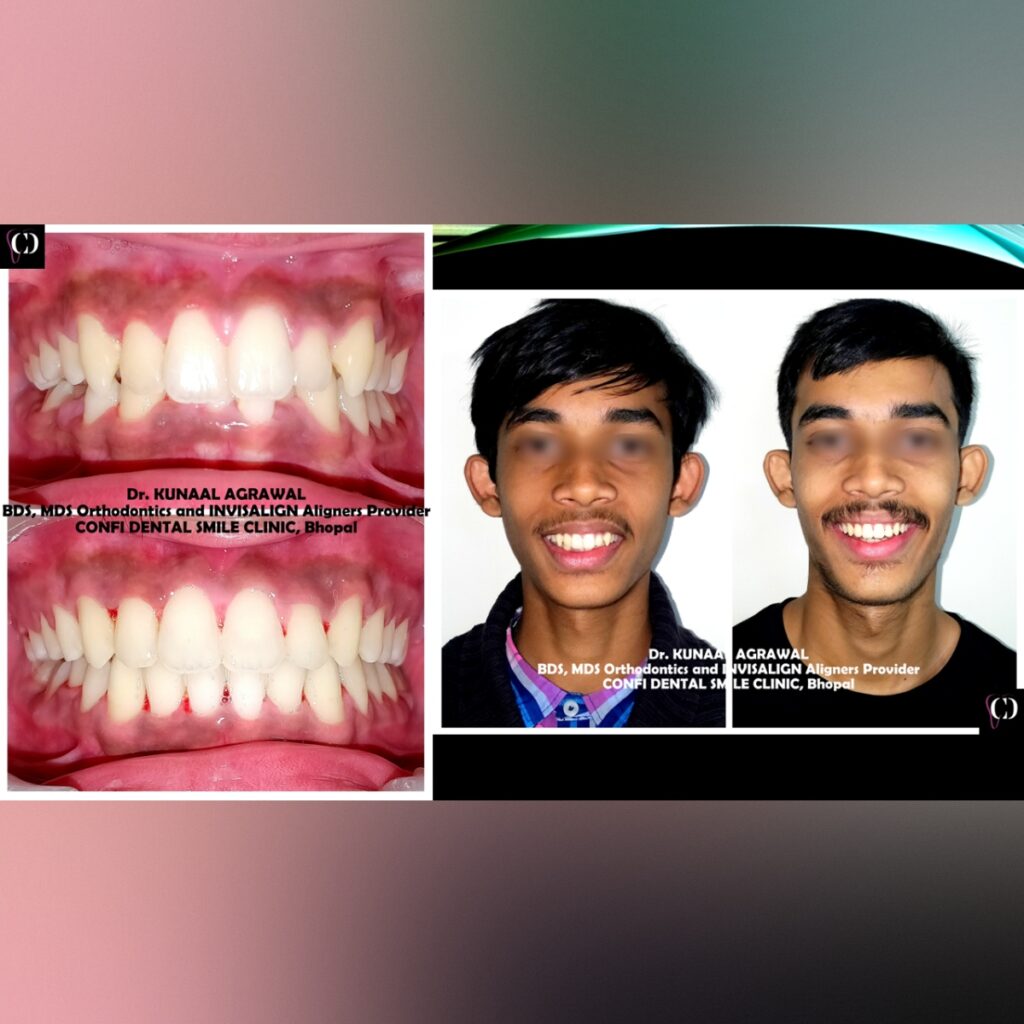an intraoral and extraoral smile comparison image of a patient who underwent orthodontic or braces treatment at confi dental smile clinic, bhopal