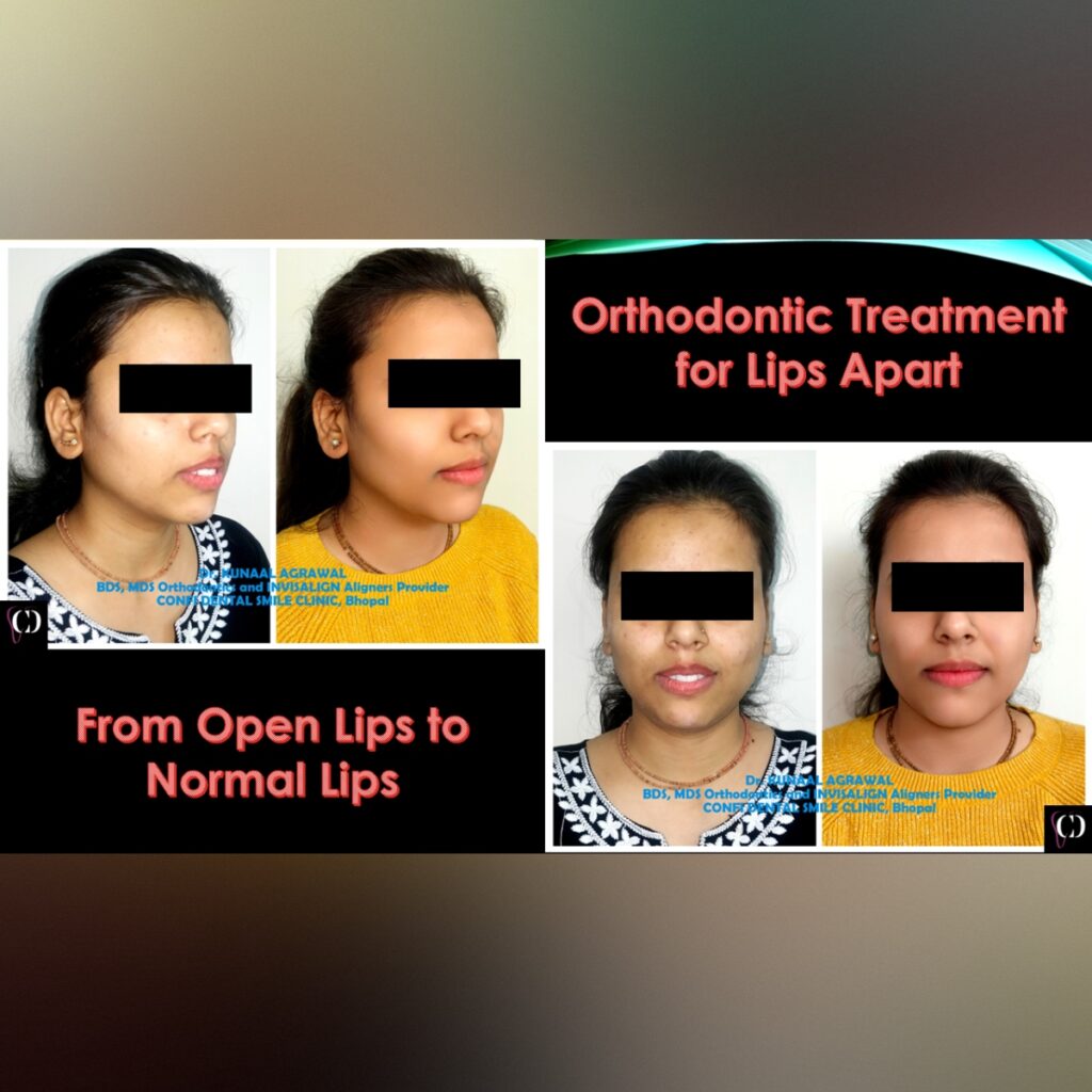 an intraoral and extraoral smile comparison image of a patient who underwent orthodontic or braces treatment at confi dental smile clinic, bhopal