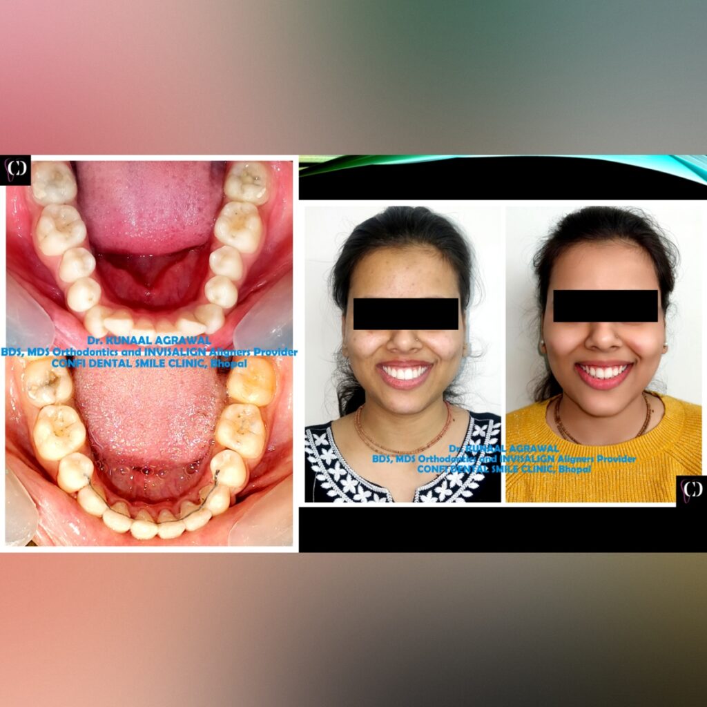 an intraoral and extraoral smile comparison image of a patient who underwent orthodontic or braces treatment at confi dental smile clinic, bhopal