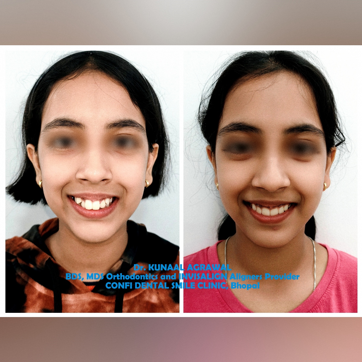 Dental braces treatment in Bhopal