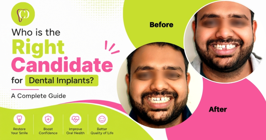 Dental implants