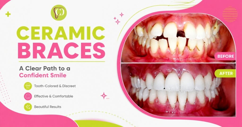 Ceramic Braces Bhopal