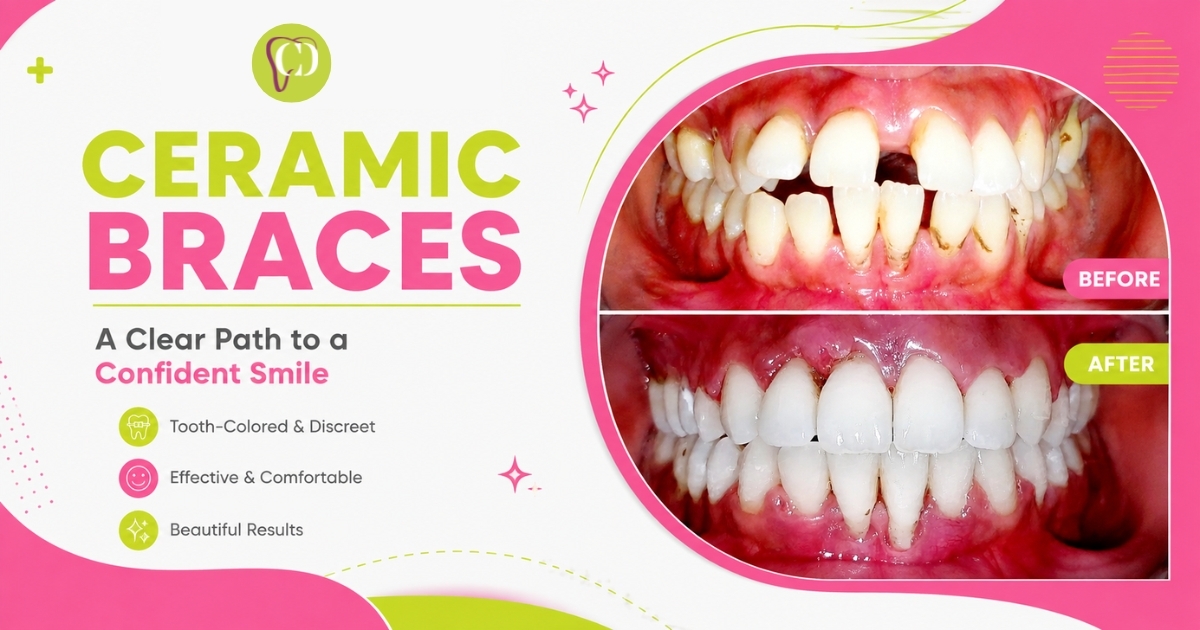 Ceramic Braces Bhopal