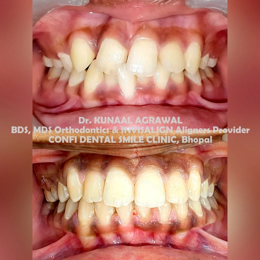 Dental Alignment Treatment Results