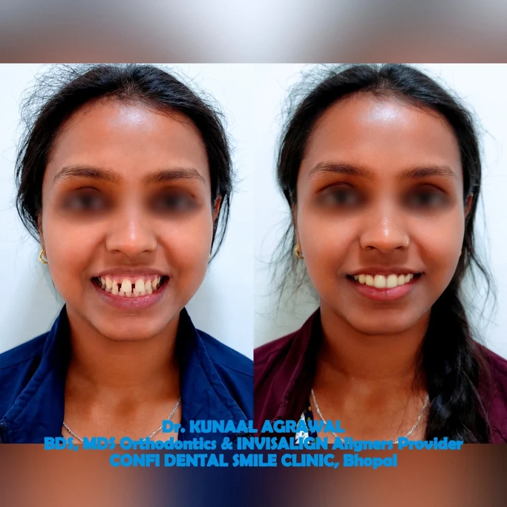 Orthodontic Smile Transformation Before After