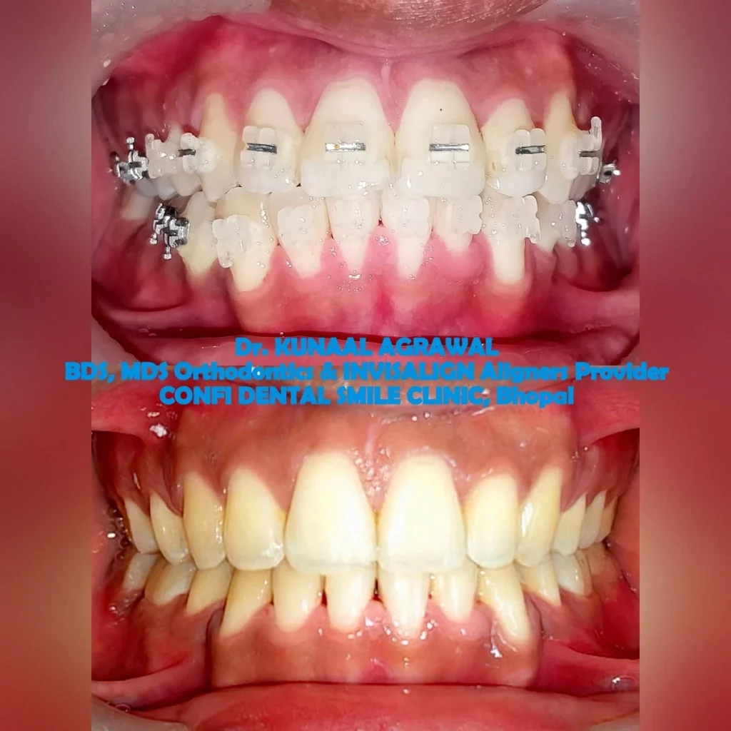 Braces Treatment Before After