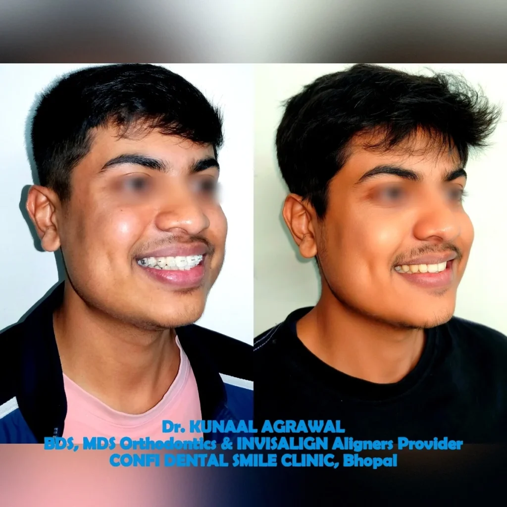 Teeth Alignment Treatment Before After