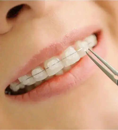 Orthodontist adjusting ceramic braces on teeth