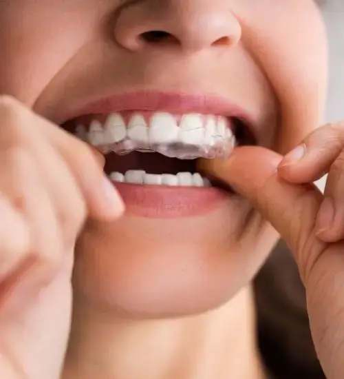 Clear aligners for straighter teeth