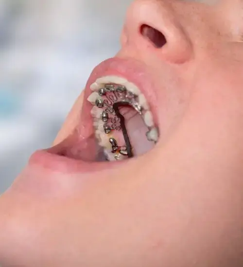 Ceramic braces for teeth alignment